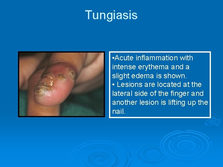 Tungiasis • Acute inflammation with intense erythema and a slight edema is shown. •