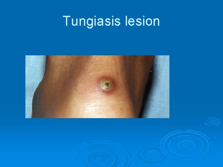 Tungiasis lesion 