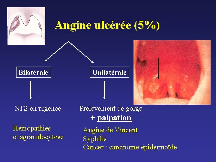 Angine ulcérée (5%) Bilatérale NFS en urgence Unilatérale Prélèvement de gorge + palpation Hémopathies Angine ulcérée (5%) Bilatérale NFS en urgence Unilatérale Prélèvement de gorge + palpation Hémopathies