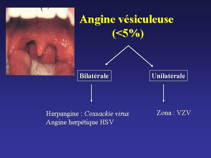 Angine vésiculeuse (<5%) Bilatérale Herpangine : Coxsackie virus Angine herpétique HSV Unilatérale Zona : Angine vésiculeuse (<5%) Bilatérale Herpangine : Coxsackie virus Angine herpétique HSV Unilatérale Zona :