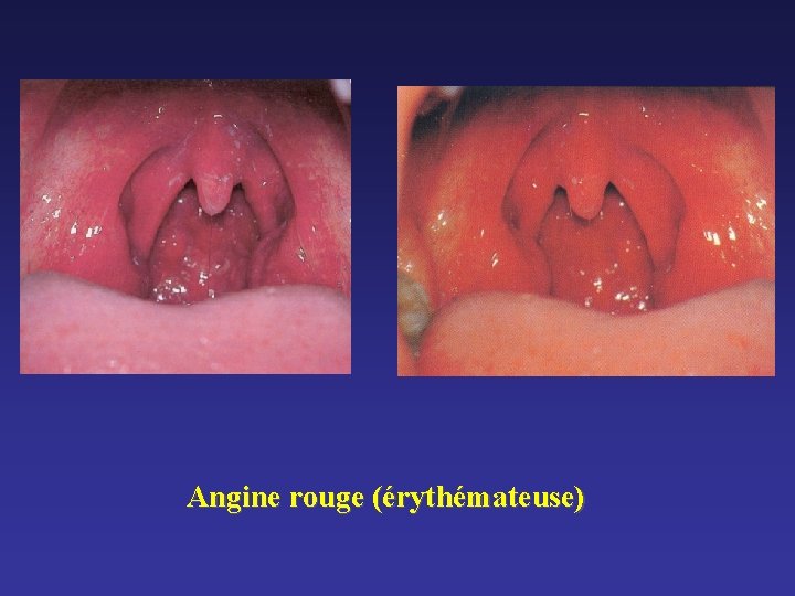 Angine rouge (érythémateuse) Angine rouge (érythémateuse)