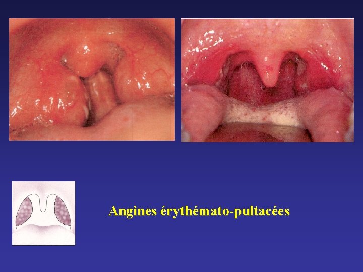 Angines érythémato-pultacées Angines érythémato-pultacées