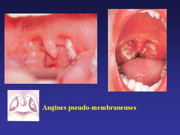 Angines pseudo-membraneuses Angines pseudo-membraneuses