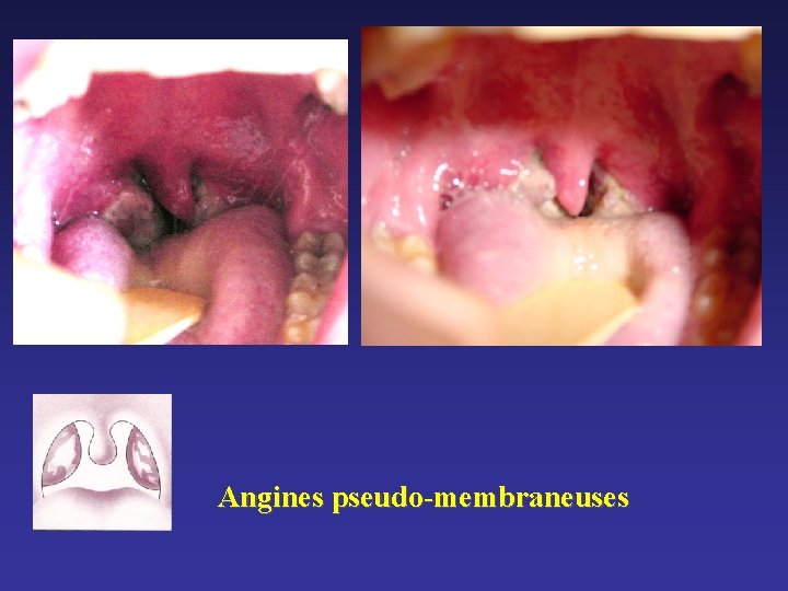 Angines pseudo-membraneuses Angines pseudo-membraneuses