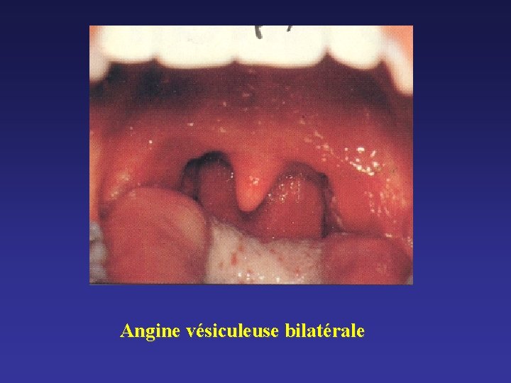 Angine vésiculeuse bilatérale Angine vésiculeuse bilatérale