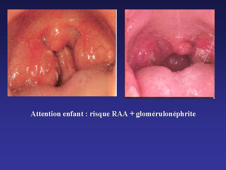 Attention enfant : risque RAA + glomérulonéphrite Attention enfant : risque RAA + glomérulonéphrite