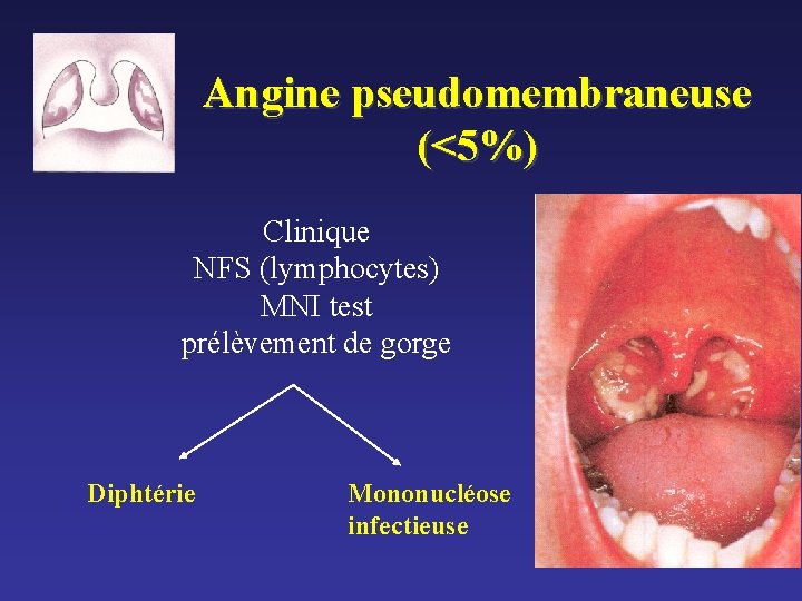 Angine pseudomembraneuse (<5%) Clinique NFS (lymphocytes) MNI test prélèvement de gorge Diphtérie Mononucléose infectieuse Angine pseudomembraneuse (<5%) Clinique NFS (lymphocytes) MNI test prélèvement de gorge Diphtérie Mononucléose infectieuse