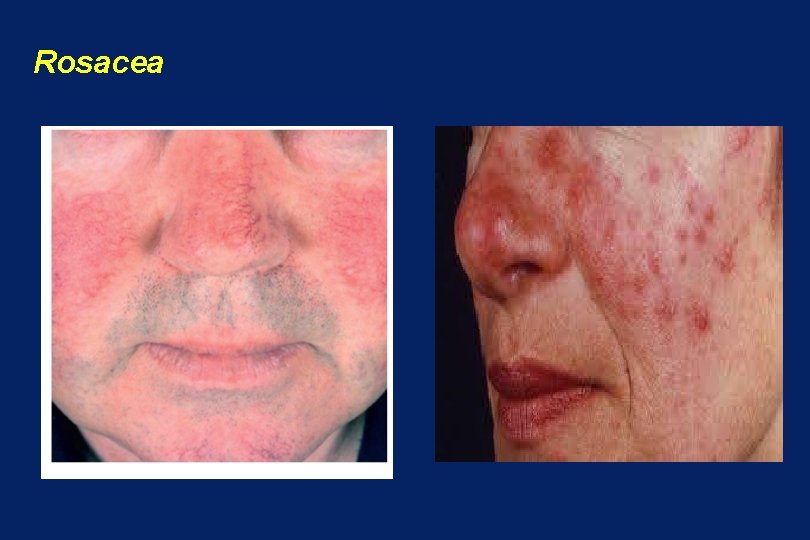 Rosacea 