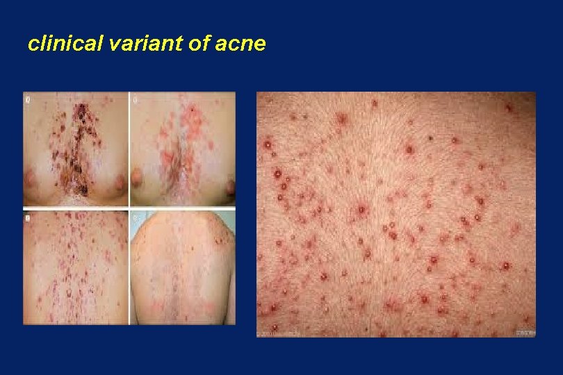 clinical variant of acne 