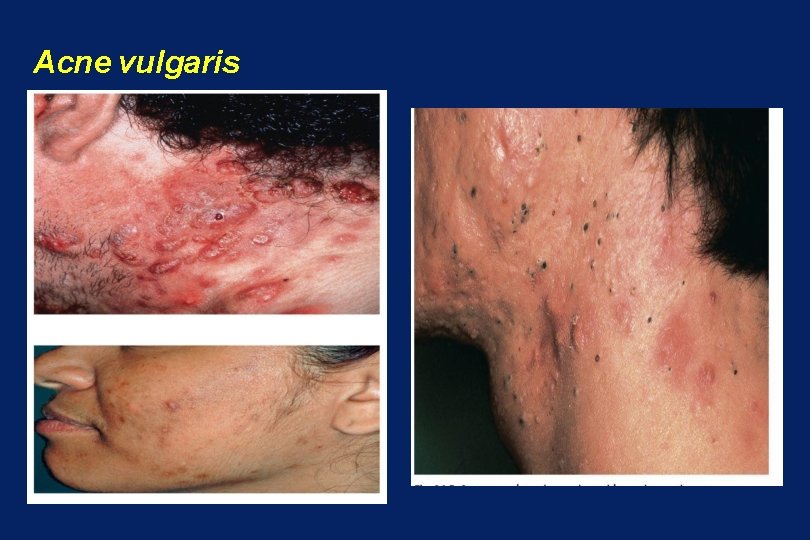 Acne vulgaris 