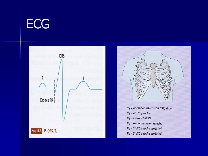 ECG 