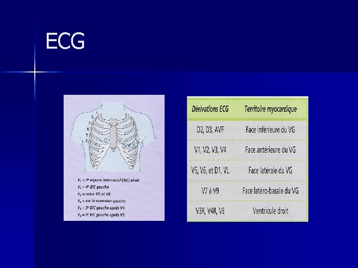 ECG 