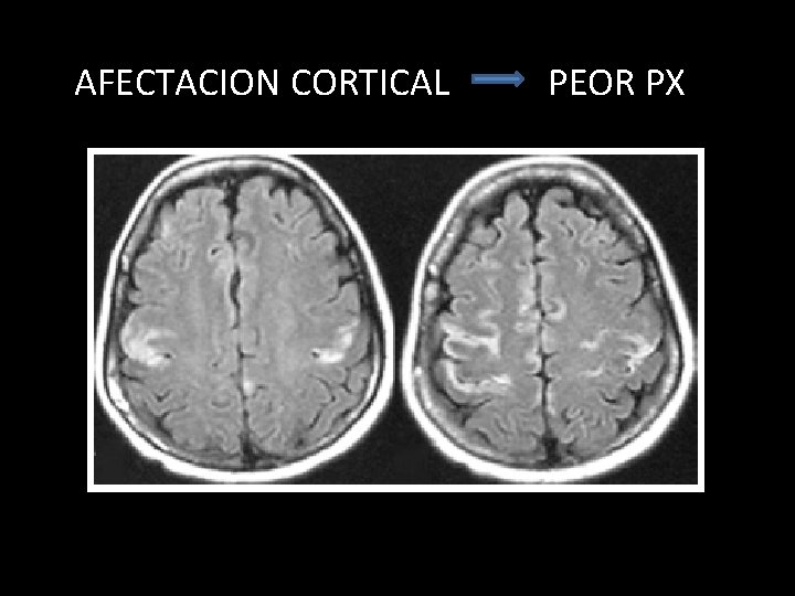 AFECTACION CORTICAL PEOR PX 