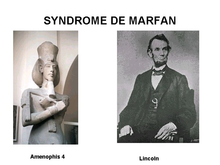 SYNDROME DE MARFAN Amenophis 4 Lincoln 