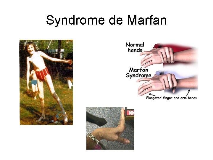 Syndrome de Marfan 