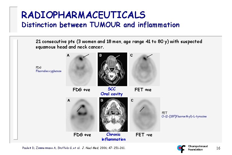 RADIOPHARMACEUTICALS Distinction between TUMOUR and inflammation 21 consecutive pts (3 women and 18 men,