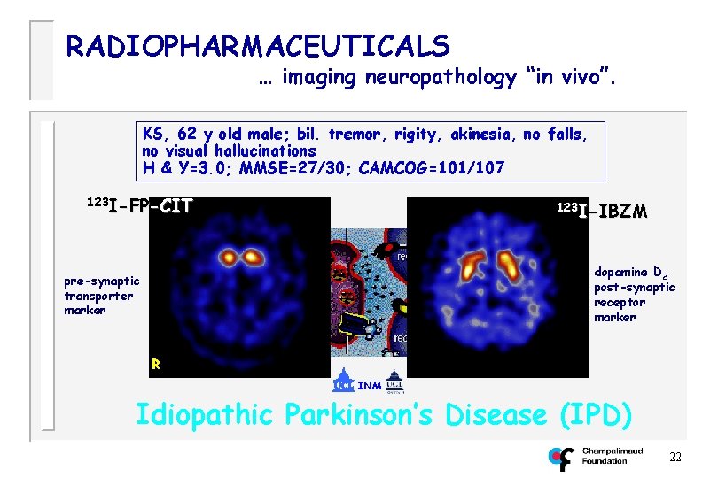 RADIOPHARMACEUTICALS … imaging neuropathology “in vivo”. KS, 62 y old male; bil. tremor, rigity,