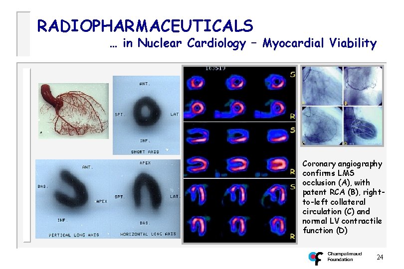 RADIOPHARMACEUTICALS … in Nuclear Cardiology – Myocardial Viability Coronary angiography confirms LMS occlusion (A),