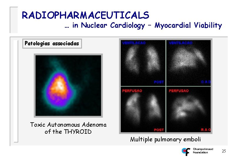 RADIOPHARMACEUTICALS … in Nuclear Cardiology – Myocardial Viability Patologias associadas Toxic Autonomous Adenoma of