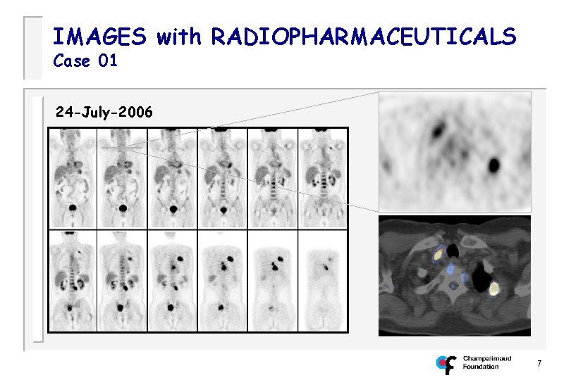 IMAGES with RADIOPHARMACEUTICALS Case 01 24 -July-2006 7 