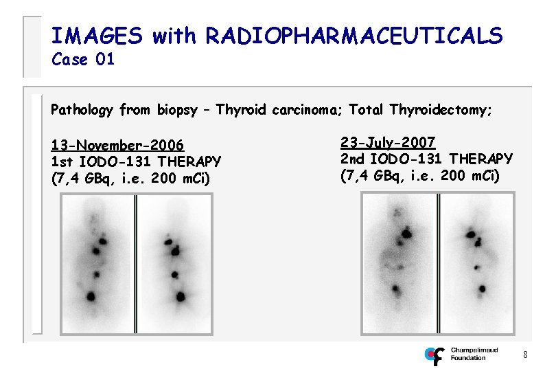 IMAGES with RADIOPHARMACEUTICALS Case 01 Pathology from biopsy – Thyroid carcinoma; Total Thyroidectomy; 13