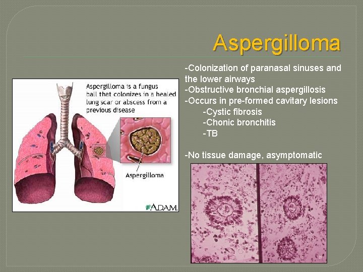 Aspergilloma -Colonization of paranasal sinuses and the lower airways -Obstructive bronchial aspergillosis -Occurs in Aspergilloma -Colonization of paranasal sinuses and the lower airways -Obstructive bronchial aspergillosis -Occurs in