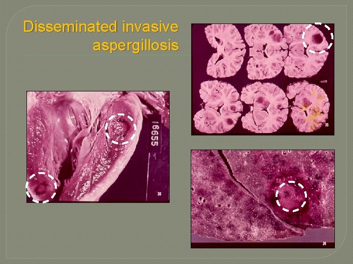 Disseminated invasive aspergillosis Disseminated invasive aspergillosis