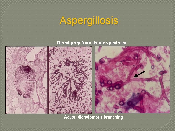 Aspergillosis Direct prep from tissue specimen Acute, dichotomous branching Aspergillosis Direct prep from tissue specimen Acute, dichotomous branching