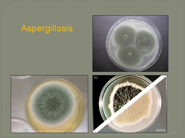 Aspergillosis Aspergillosis