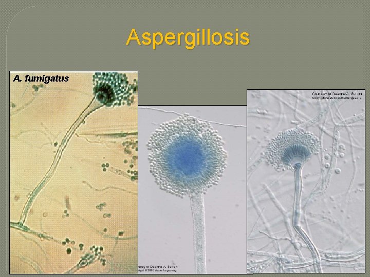 Aspergillosis A. fumigatus Aspergillosis A. fumigatus