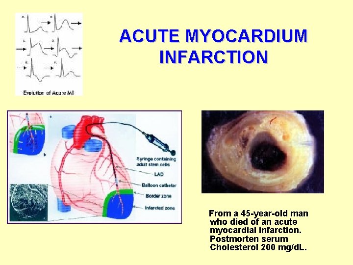 ACUTE MYOCARDIUM INFARCTION From a 45 -year-old man who died of an acute myocardial