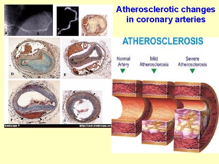 Atherosclerotic changes in coronary arteries 