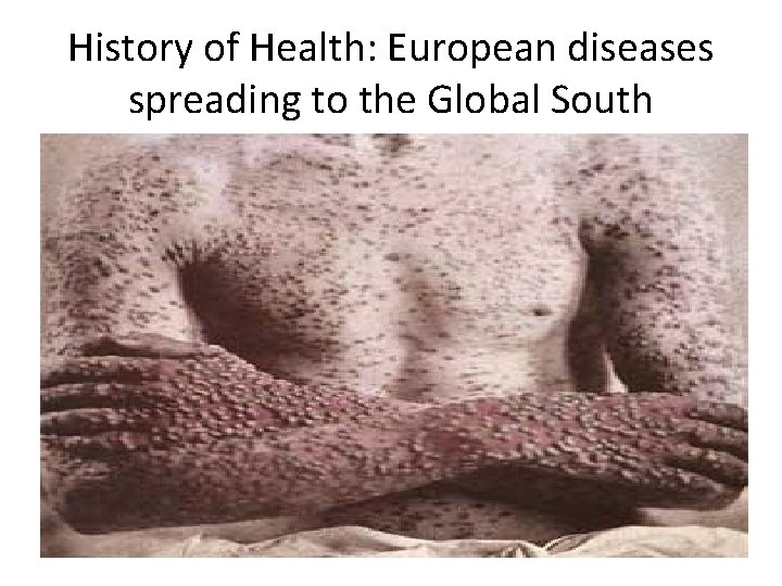 History of Health: European diseases spreading to the Global South 