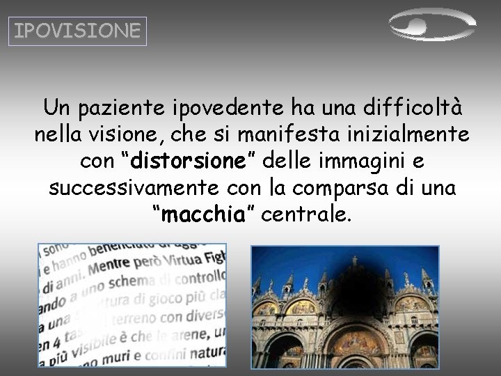 IPOVISIONE Un paziente ipovedente ha una difficoltà nella visione, che si manifesta inizialmente con IPOVISIONE Un paziente ipovedente ha una difficoltà nella visione, che si manifesta inizialmente con
