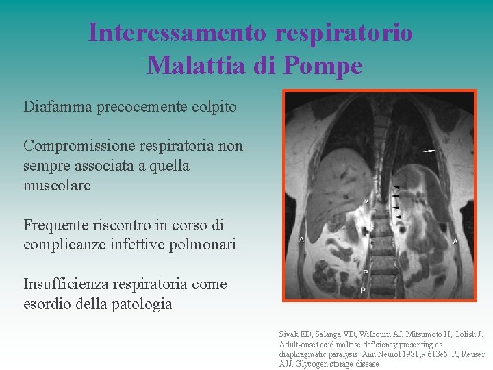 Interessamento respiratorio Malattia di Pompe Diafamma precocemente colpito Compromissione respiratoria non sempre associata a