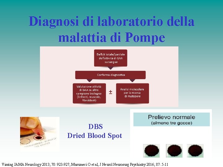 Diagnosi di laboratorio della malattia di Pompe DBS Dried Blood Spot Vissing JAMA Neurology