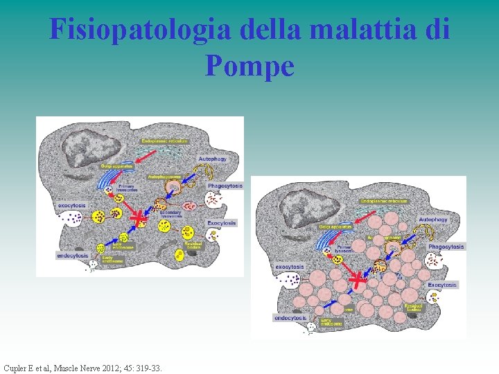 Fisiopatologia della malattia di Pompe Cupler E et al, Muscle Nerve 2012; 45: 319