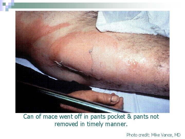 Can of mace went off in pants pocket & pants not removed in timely Can of mace went off in pants pocket & pants not removed in timely