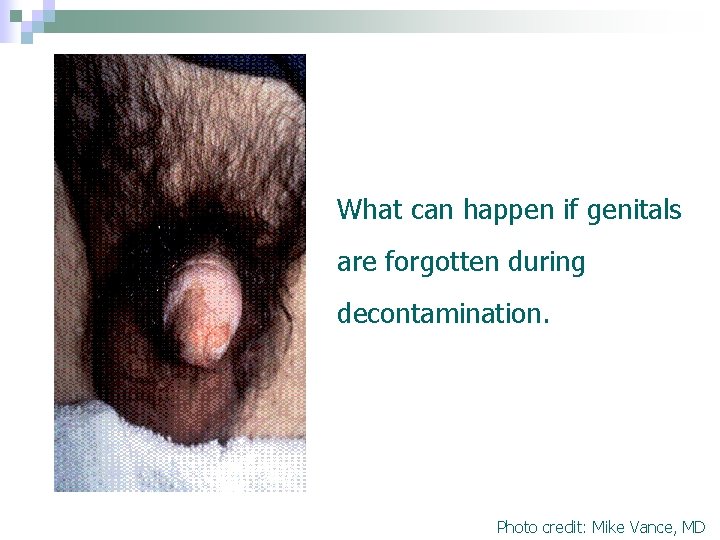 What can happen if genitals are forgotten during decontamination. Photo credit: Mike Vance, MD What can happen if genitals are forgotten during decontamination. Photo credit: Mike Vance, MD