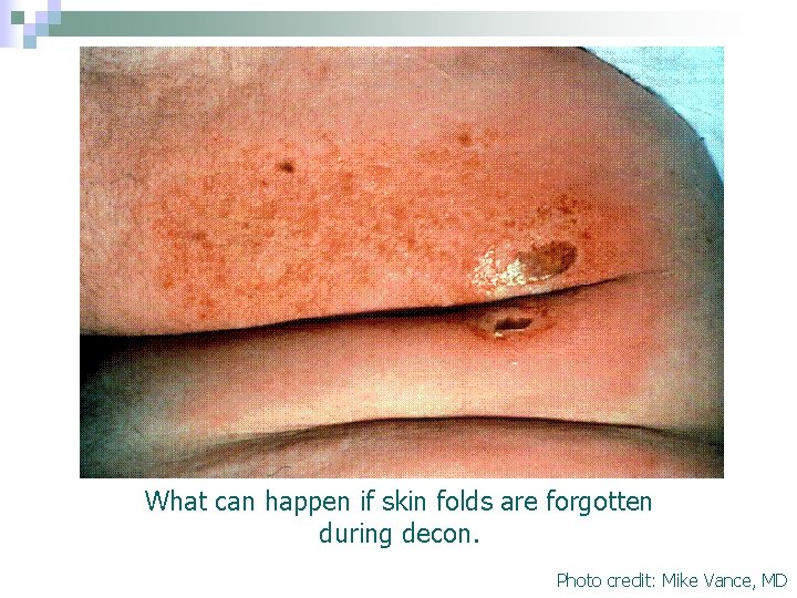 What can happen if skin folds are forgotten during decon. Photo credit: Mike Vance, What can happen if skin folds are forgotten during decon. Photo credit: Mike Vance,