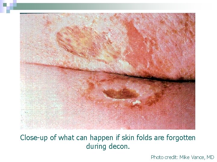 Close-up of what can happen if skin folds are forgotten during decon. Photo credit: Close-up of what can happen if skin folds are forgotten during decon. Photo credit: