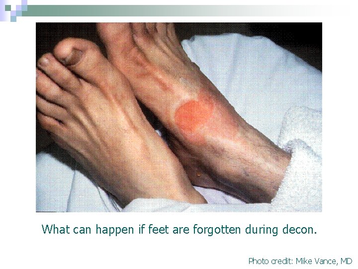 What can happen if feet are forgotten during decon. Photo credit: Mike Vance, MD What can happen if feet are forgotten during decon. Photo credit: Mike Vance, MD