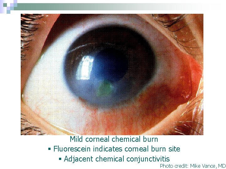 Mild corneal chemical burn § Fluorescein indicates corneal burn site § Adjacent chemical conjunctivitis Mild corneal chemical burn § Fluorescein indicates corneal burn site § Adjacent chemical conjunctivitis