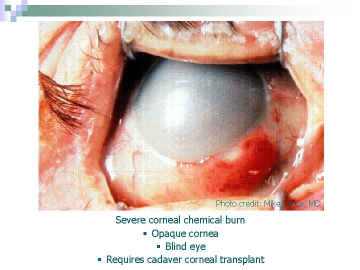 Photo credit: Mike Vance, MD Severe corneal chemical burn § Opaque cornea § Blind Photo credit: Mike Vance, MD Severe corneal chemical burn § Opaque cornea § Blind