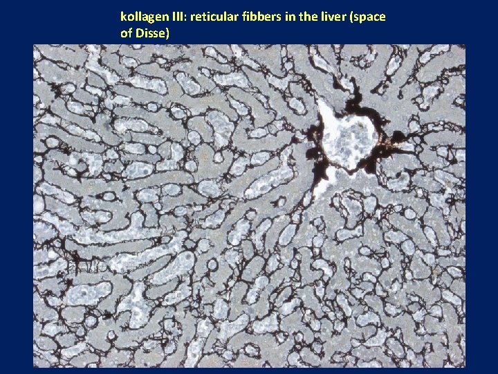 kollagen III: reticular fibbers in the liver (space of Disse) 