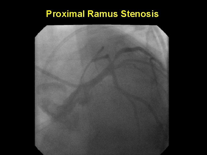 Proximal Ramus Stenosis 