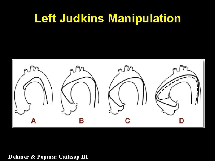 Left Judkins Manipulation Dehmer & Popma: Cathsap III 