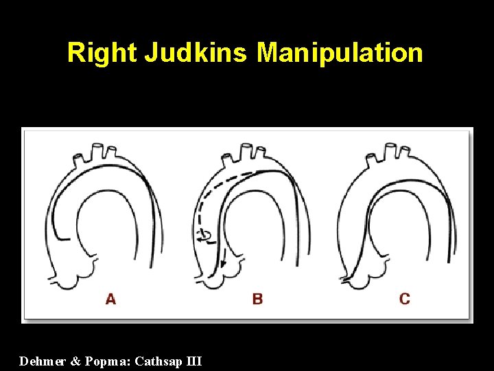 Right Judkins Manipulation Dehmer & Popma: Cathsap III 