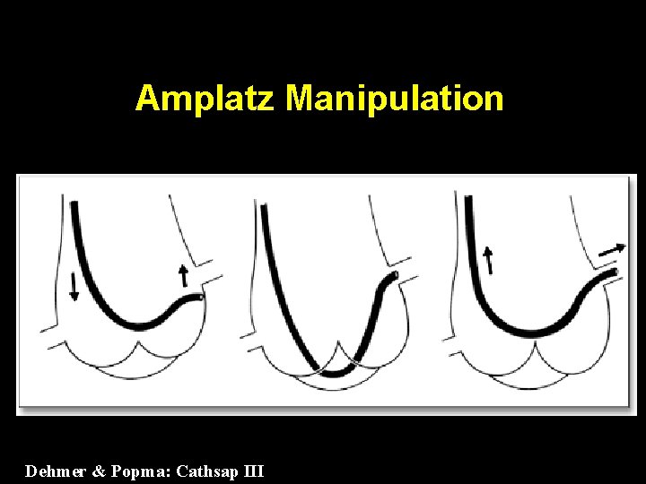 Amplatz Manipulation Dehmer & Popma: Cathsap III 