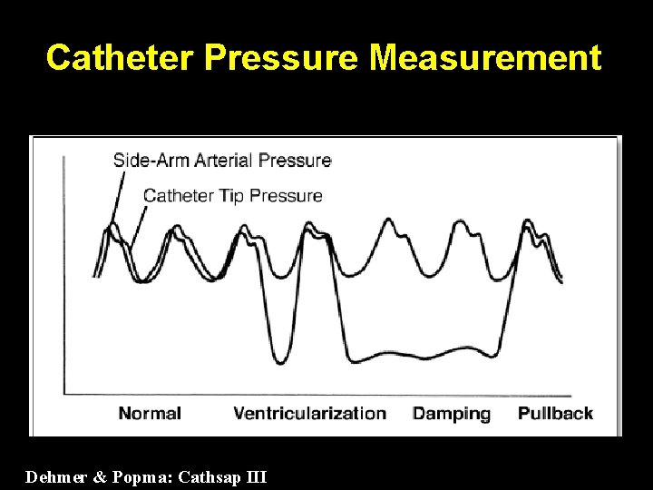 Catheter Pressure Measurement Dehmer & Popma: Cathsap III 